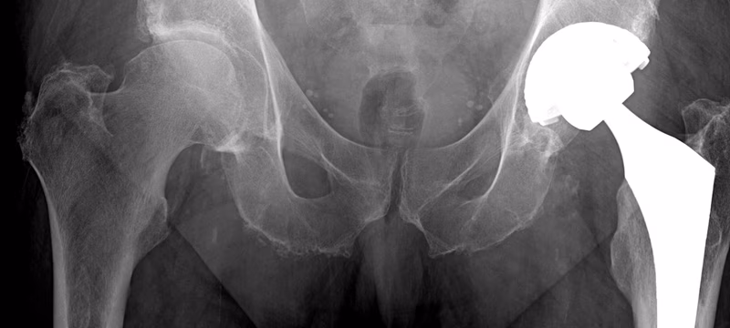 DISH Pelvis Osseous Whiskering