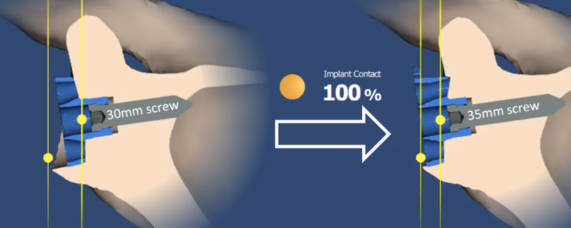 Glenoid augments
