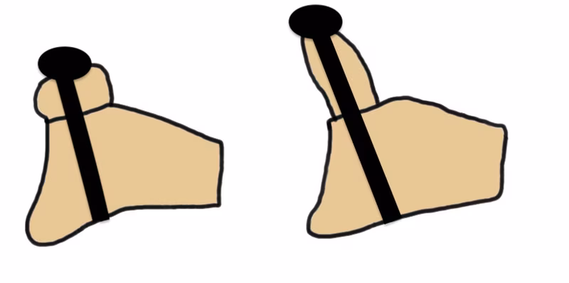 latarjet