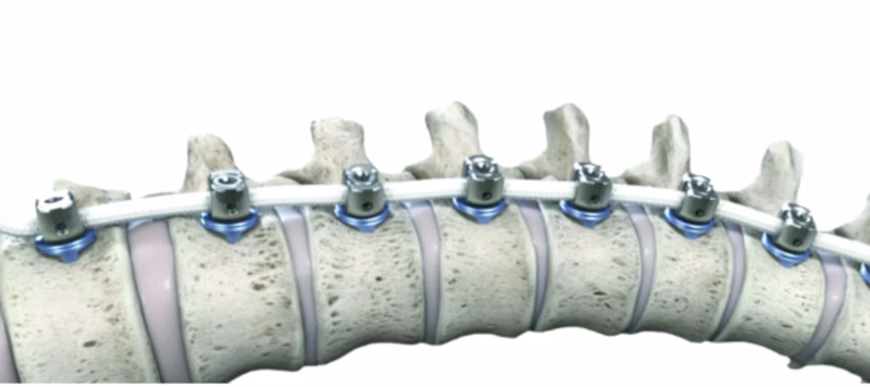 Anterior vertebral body tethering