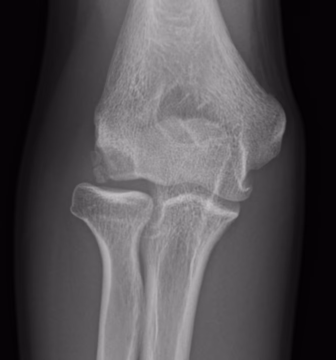 Panners disease