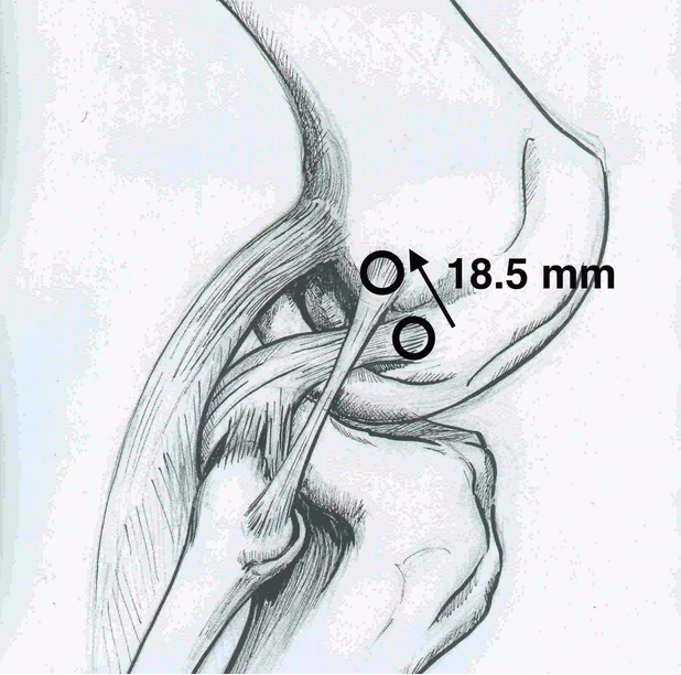 PLC Femoral tunnels
